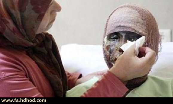 اعتراف رئیس پلیس ایران به گسترش فرهنگ ننگین اسید پاشی در جامعه اعتراف رئیس پلیس ایران به گسترش فرهنگ ننگین اسید پاشی در جامعه