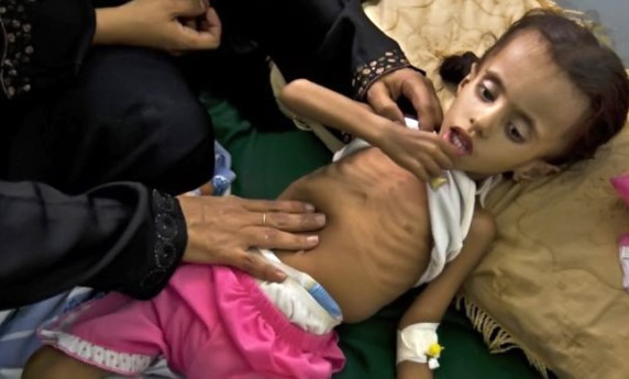 سوء تغذیه جان مادران و کودکان بلوچ را در معرض خطر قرار داده
