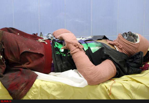 آمار سوختگی در ایران هشت برابر متوسط جهانی است آمار سوختگی در ایران هشت برابر متوسط جهانی است