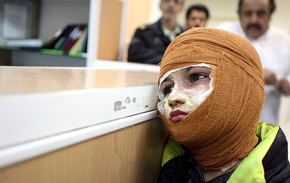اعتراف کارگزاران رژیم به مرگ روزانه ۱۰نفر در ایران بهدلیل سوختگی اعتراف کارگزاران رژیم به مرگ روزانه ۱۰نفر در ایران بهدلیل سوختگی